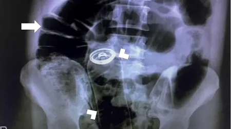 Medicii au fost nevoiți să opereze de urgență un bărbat care s-a prezentat la spital cu un deodorant blocat în ANUS