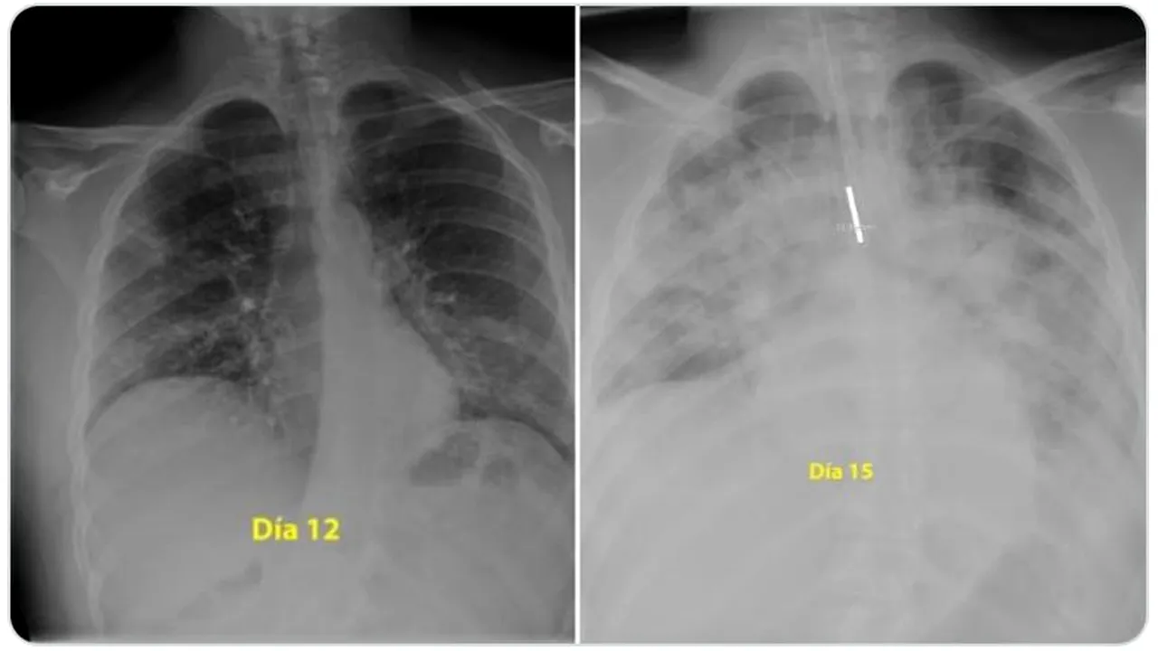 Cum macină organismul virusul SARS-CoV-2. În trei zile, coronavirusul îți „mănâncă” ambii plămâni!