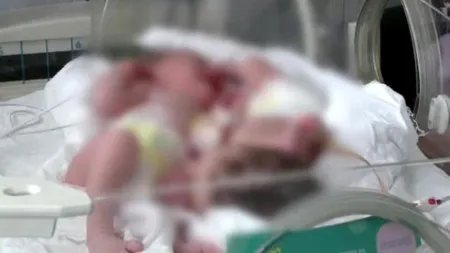 Siamezele Maria și Elena, operate la București, au luat în greutate și ar putea fi externate în două-trei zile