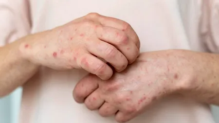 Au fost depistate cazuri de râie la Spitalul de Psihiatrie din Jebel. DSP Timiş a demarat o anchetă