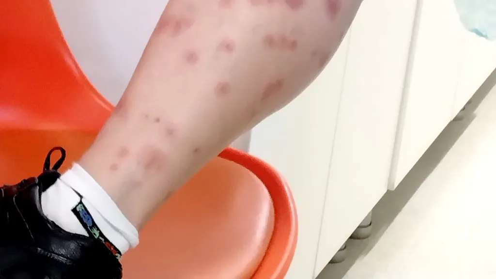 O turistă a fost mușcată de ploșnițe într-un hotel din România. Femeia a ajuns la spital
