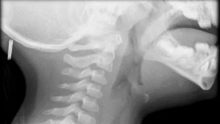 Un tânăr din China a șocat lumea medicală. Ce au descoperit doctorii în gâtul lui