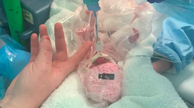 Un bebeluș născut prematur a supraviețuit ca prin minune! Medicii au folosit o metodă neobișnuită: punga de sandvici