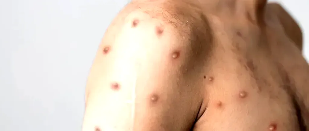 Un nou caz de variola maimuţei a fost confirmat în România. Bilanțul total a ajuns la 42