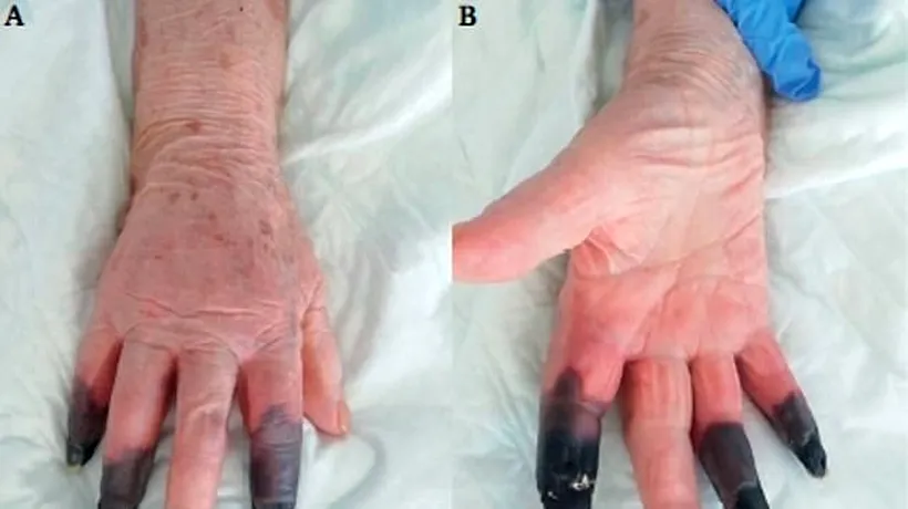 Imagini șocante: Medicii au amputat trei degete unei paciente cu COVID-19, după ce i s-au înnegrit