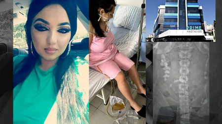 EXCLUSIV | O româncă era să moară după ce a făcut operație de micșorare a stomacului în Turcia. „Mi-au dat morfină și mi-au spus că sunt sănătoasă”