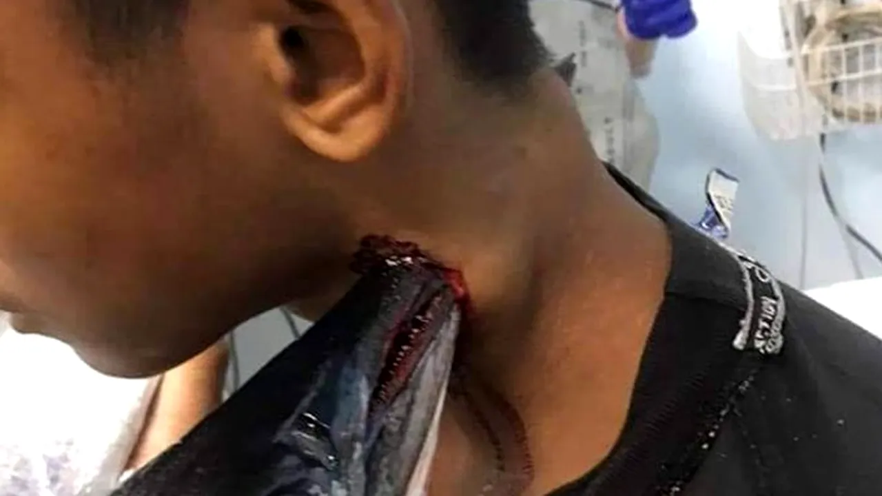 Uimitor. Un pește a sărit din apă și i-a străpuns gâtul unui tânăr care pescuia liniștit - FOTO
