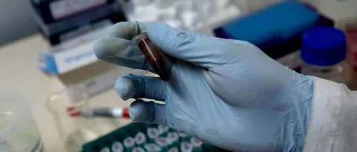 Un test sangvin distinge nodulii pulmonari benigni de cei canceroși