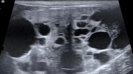 Un bărbat și-a purtat în burtă fratele geamăn timp de 36 de ani. FOTO cu „gravidul” care a uimit lumea științei