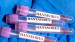 Un nou caz de hantavirus a apărut în Spania. Numărul persoanelor infectate a ajuns la 13