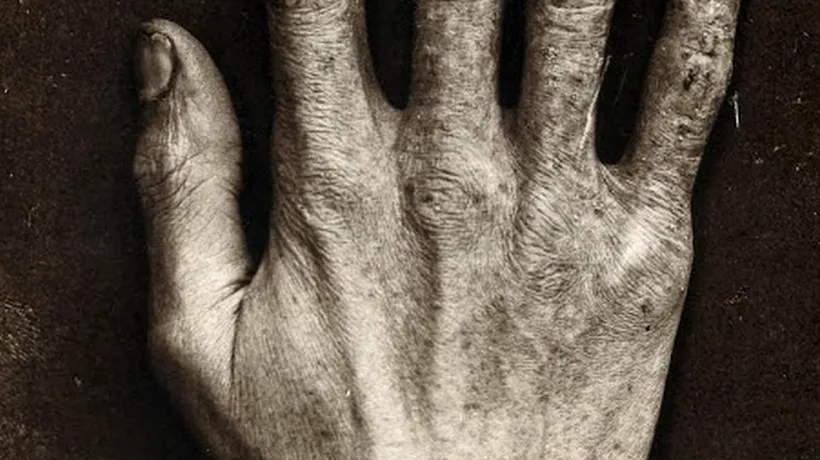 Șocant: Cum arăta mâna omului care a testat tuburi cu raze X pentru celebrul inventator Thomas Edison - FOTO