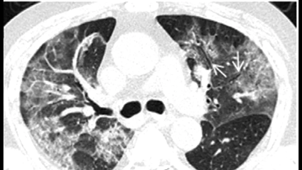 CORONAVIRUS | Testele nu sunt singura metodă de diagnosticare: RADIOGRAFIA, decisivă în tratamentul pacienților și managementul spitalelor