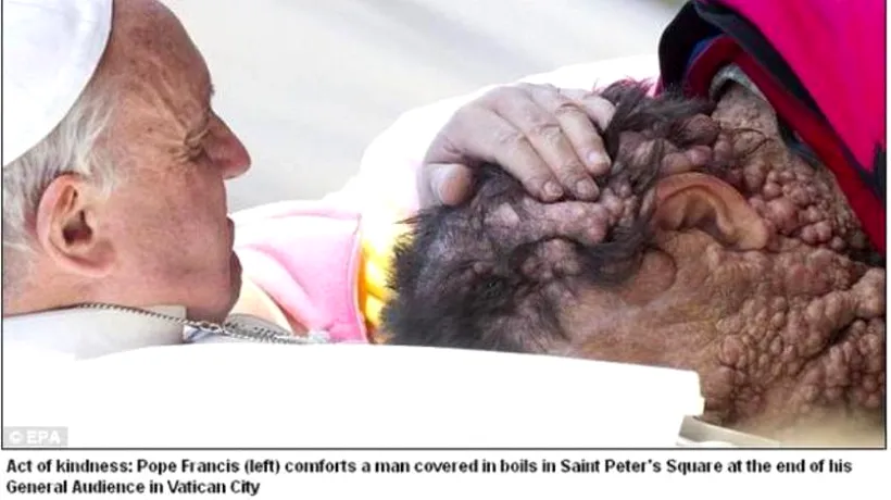 FOTO. Povestea emoționantă a bărbatului cu o boală gravă de piele sărutat de Papa Francisc