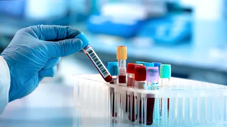 Analiza de sânge care ajută la identificarea a peste 50 de tipuri de cancer