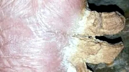 Unei femei din Arabia Saudită i-au crescut în talpă „coarne