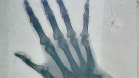 Radiografia mâinii drepte a reginei Elisabeta, vândută la licitație pentru 800 de euro