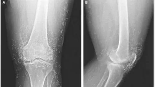 Descoperire facută după o radiografie: Femeia are o comoară în genunchi. Anunțul făcut de medici
