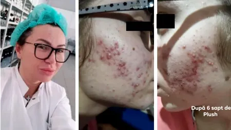 MĂRTURIE. „E strigător la cer. Voi depune plângere la fel ca restul fetelor mutilate”. Zeci de fete acuză că și-au distrus tenul după ce au folosit produse „bio și naturale”, de la ”dermatologul vedetelor”. Acum firma produce și dezinfectanți