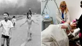 ”Fetița Napalm” din Vietnam a făcut ultimul tratament de piele la 59 de ani. Care este povestea ei