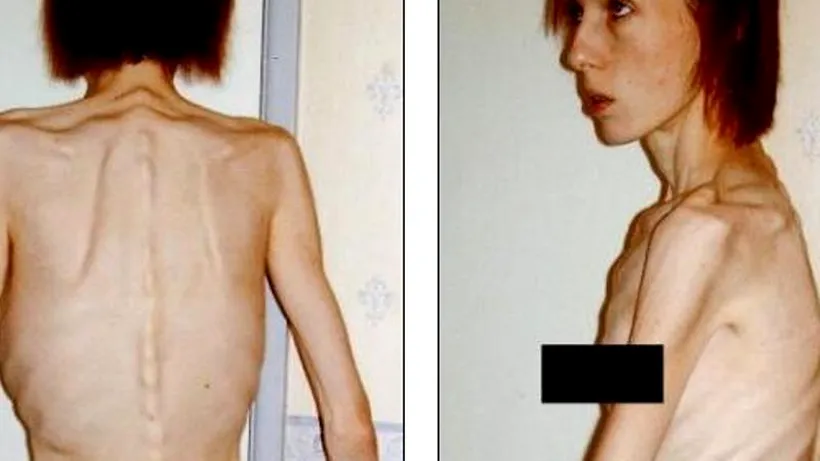 FOTO. Cum a reușit această tânără să învingă anorexia doar pentru a absolvi facultatea