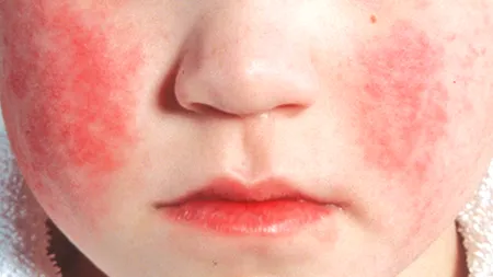 „Boala Obrajilor Pălmuiți”, afecțiunea de care puțină lume știe, dar este extrem de CONTAGIOASĂ / Medic: „La gravide, poate declanșa avortul spontan”