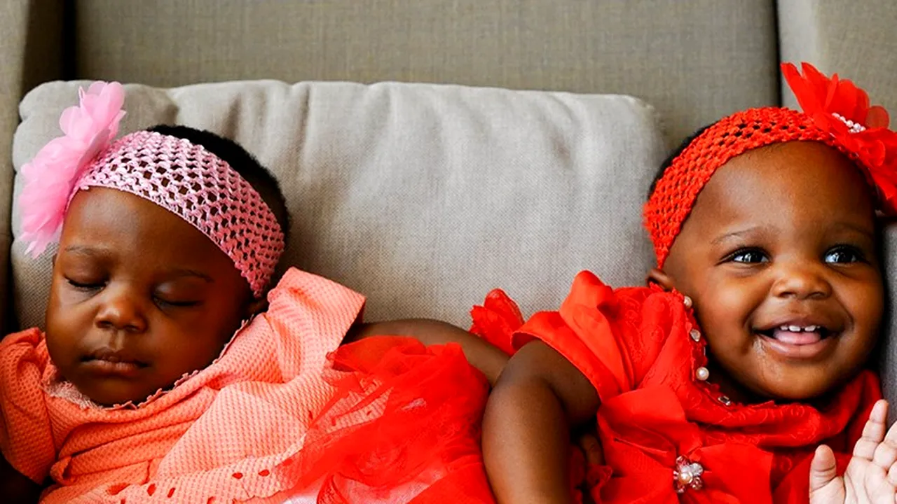 FOTO | Siameze în vârstă de 1 an, care împărțeau organe și funcții vitale, au fost separate într-o operație care a durat 27 de ore