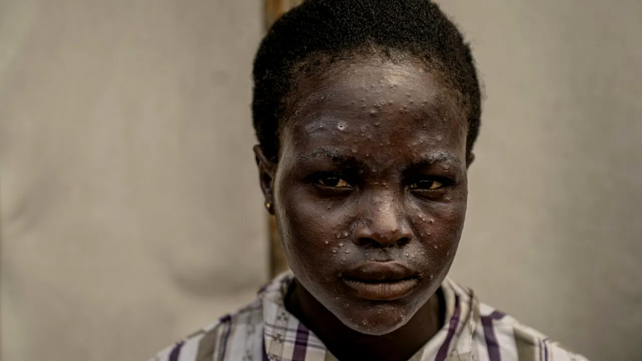 UE nu ia în considerare introducerea de controale la frontiere și adoptarea unui plan comun de vaccinare în contextul mpox