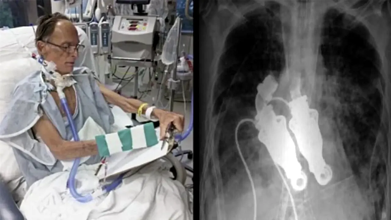 Viața bate filmul! Povestea primului om din istoria lumii care a trăit fără inimă