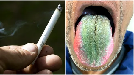 Un fumător s-a trezit cu LIMBA „verde și păroasă”. Cazul lui, trimis direct la Academia Americană de Medicină Orală