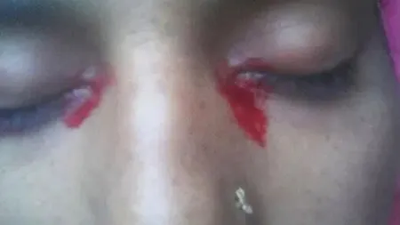 Femeia care plânge lacrimi de sânge: Ce tratament i-au administrat medicii