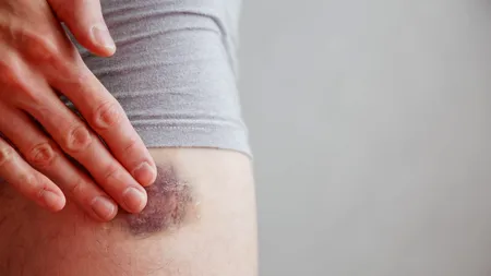 Cum explică medicii apariția VÂNĂTĂILOR pe corp, după ce ne lovim. Ce sunt echimozele și care este motivul pentru care apar