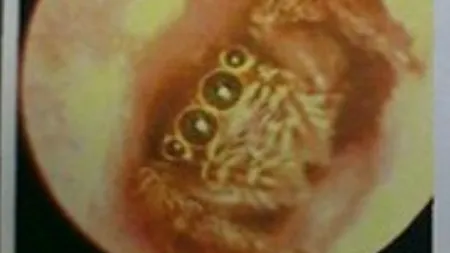 A trăit fără să știe cu un paianjen viu în ureche