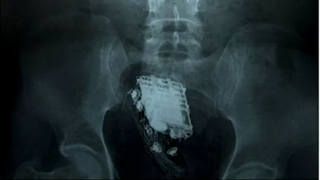 Cum a ajuns acest obiect acolo? Medicii au fost șocați