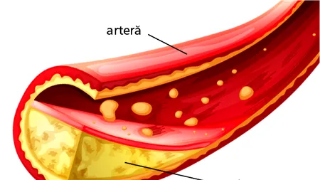 (P) Medicii: Cum se reduce colesterolul?