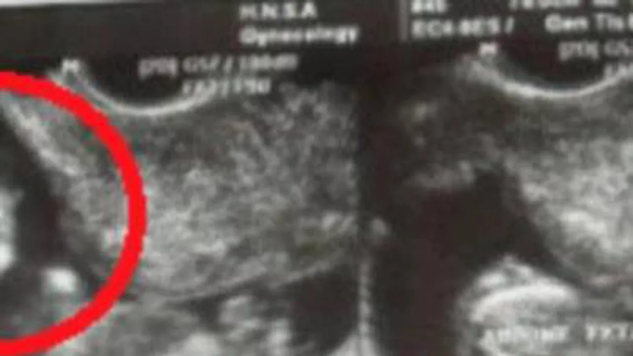 Ce surpriză a avut o gravidă când a făcut ecografie. 