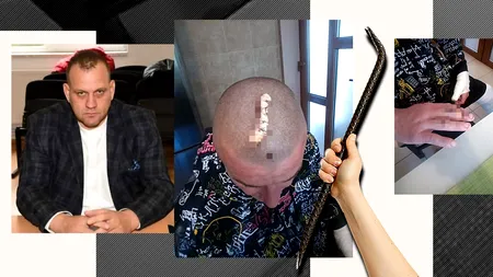 Un bărbat a fost cusut și băgat în ghips, după ce a fost BĂTUT cu ranga de un politician din Dâmbovița
