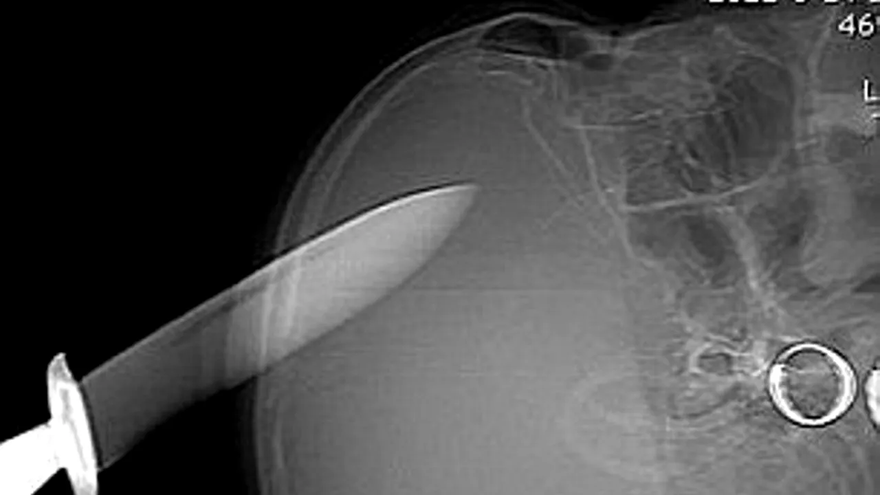 O femeie din China a supraviețuit după ce și-a înfipt în cap un cuțit