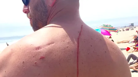 Trauma care i-a salvat viața. Un bărbat a aflat că are tumoră la rinichi după ce a fost mușcat de rechin