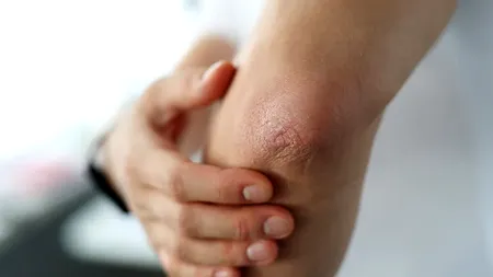 Semnul unei inimi bolnave care apare ÎN COT. Cum poți preveni infarctul sau accidentul vascular cerebral