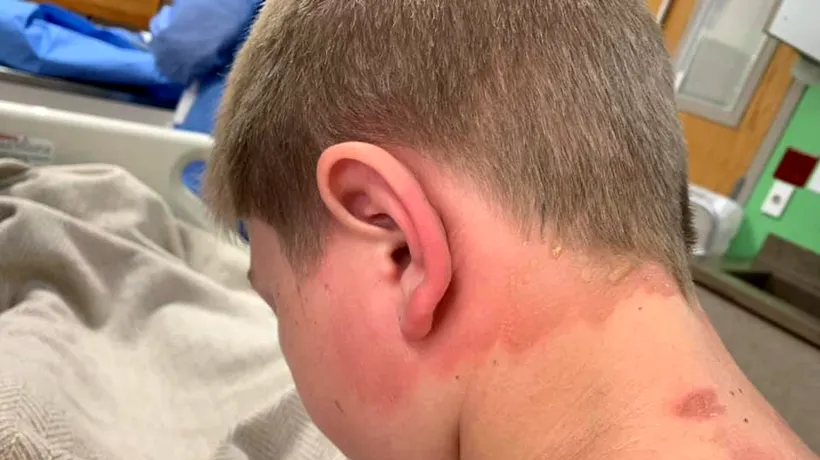 Farsă macabră. Un adolescent a ajuns la spital cu arsuri grave după ce prietenul lui a aruncat cu apă fiartă pe el chiar în timp ce dormea: Este un coșmar - VIDEO / FOTO