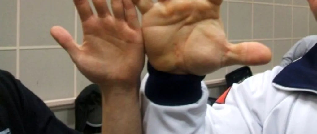 Cum arată omul cu cele mai mari mâini: „E o ciudățenie a naturii. VIDEO