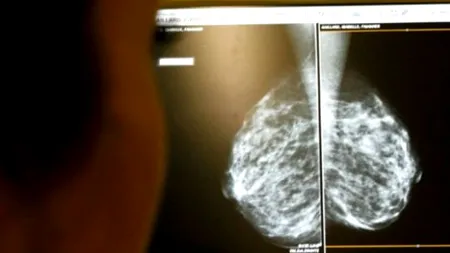 Peste un milion de femei din SUA, tratate inutil de cancer la sân în ultimii 30 de ani