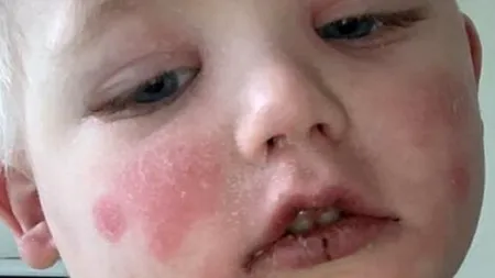 KAWASAKI. Boala care a transformat un copil de trei ani într-o „păpușă de cârpă”. Mama băiețelului avertizează: „Era inert, nu mai era nimic acolo...”