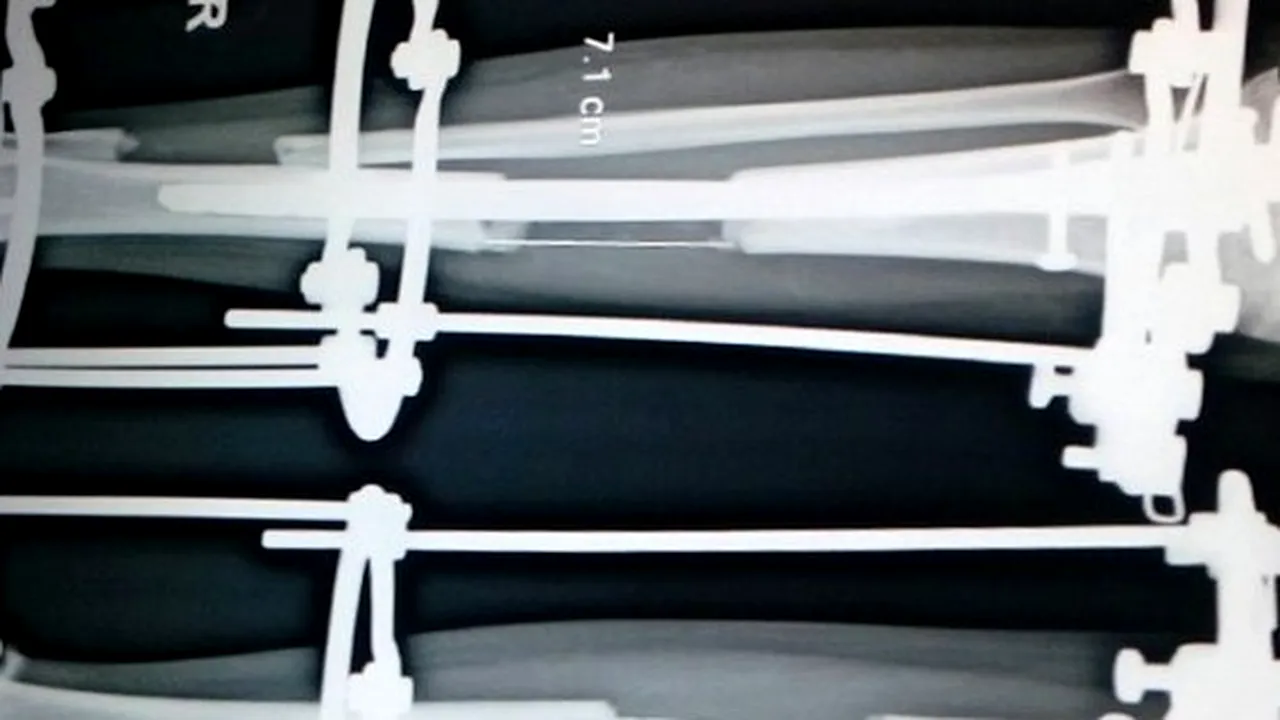 Operația extremă pe care o cer tot mai mulți pacienți. La ce chinuri se supun