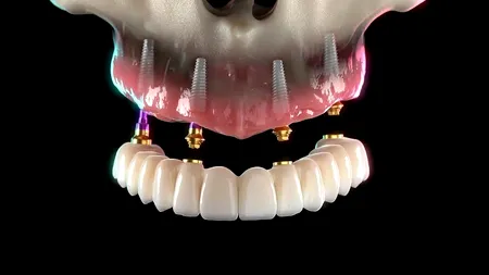 (P) Îți dorești „Dantură Fixă în 24 de ore”? Vezi dacă procedura ți se potrivește cu adevărat