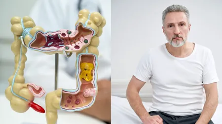 Cancerul de colon la tineri, diferit de cel apărut după 50 de ani. Ce arată un nou studiu australian