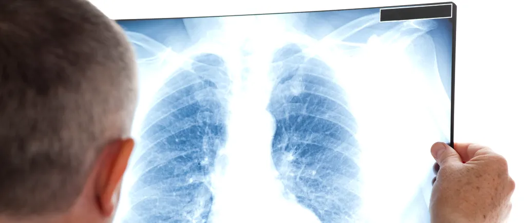 Ce a pățit o femeie, bolnavă de TBC, după ce a refuzat tratamentul împotriva tuberculozei