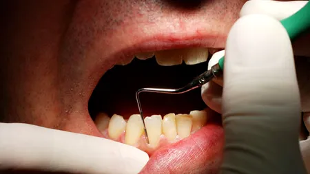 Cifre alarmante: Aproape 2 din 3 români au PROBLEME dentare / Aproape 80% preferă să ia medicamente în locul vizitei la stomatolog