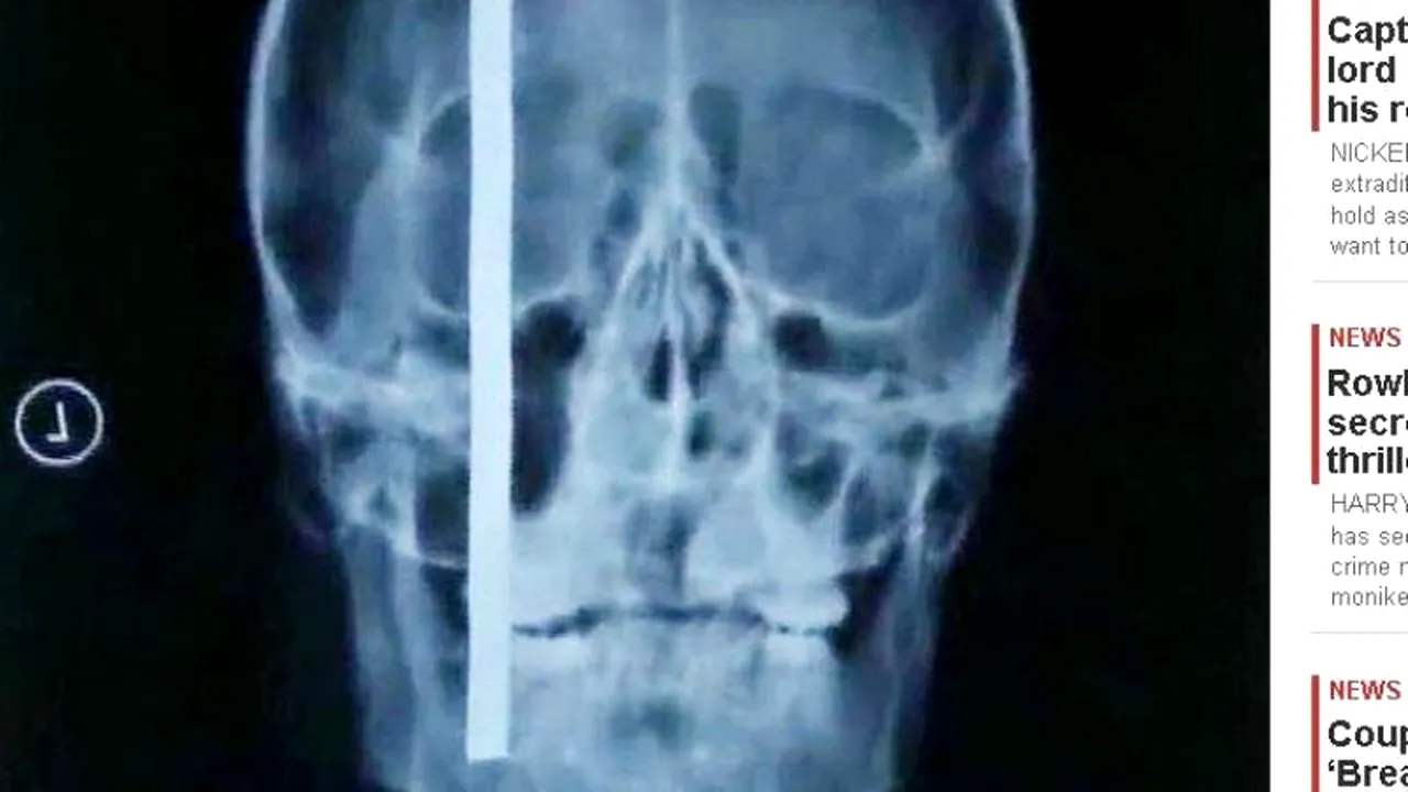 A supraviețuit după ce o bară de oțel i-a intrat 20 de centimetri în cap