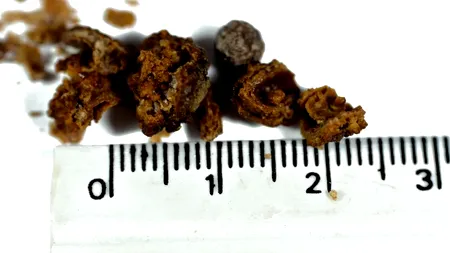 Cum să elimini pietrele la rinichi FĂRĂ PASTILE și fără să te doară